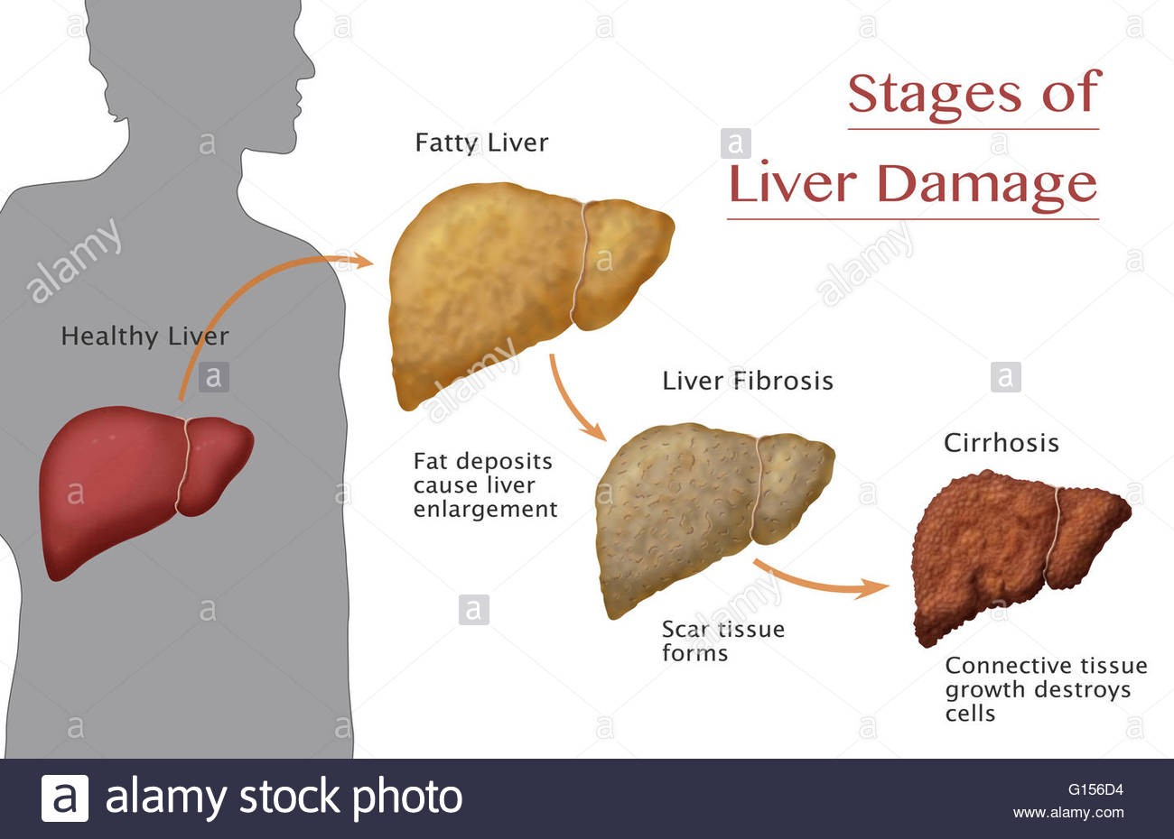 Diagram Of The Liver Artificial Intelligence In Health Care Liver Fibrosis Prostate
