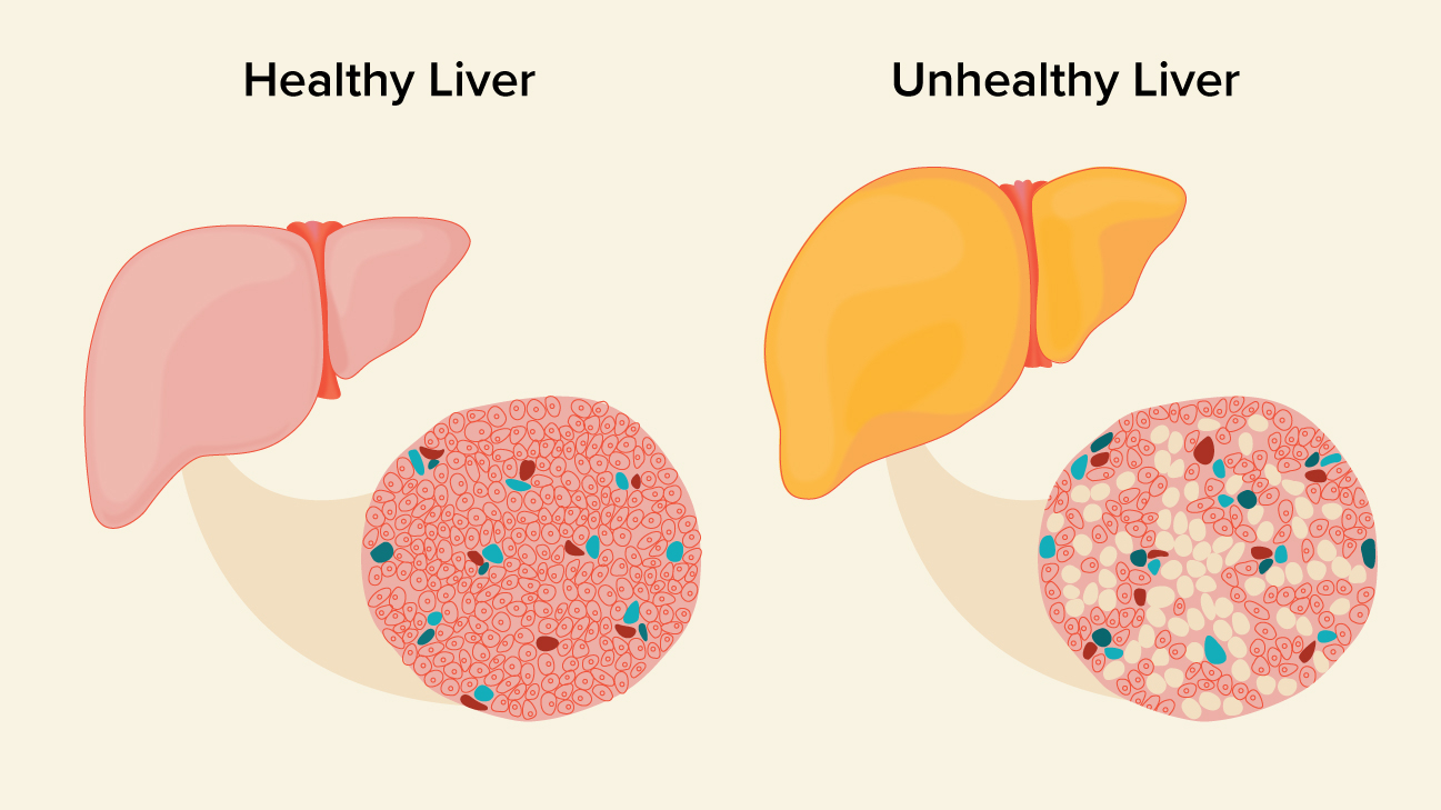 Diagram Of The Liver Fatty Liver Causes Symptoms And Diagnosis