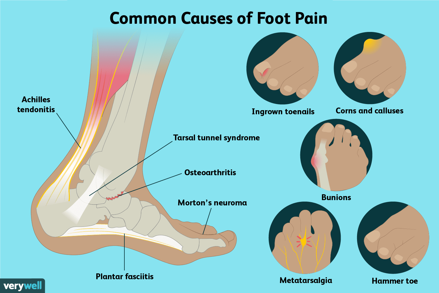 Foot Pain Diagram Foot Pain Causes Treatment And When To See A Doctor