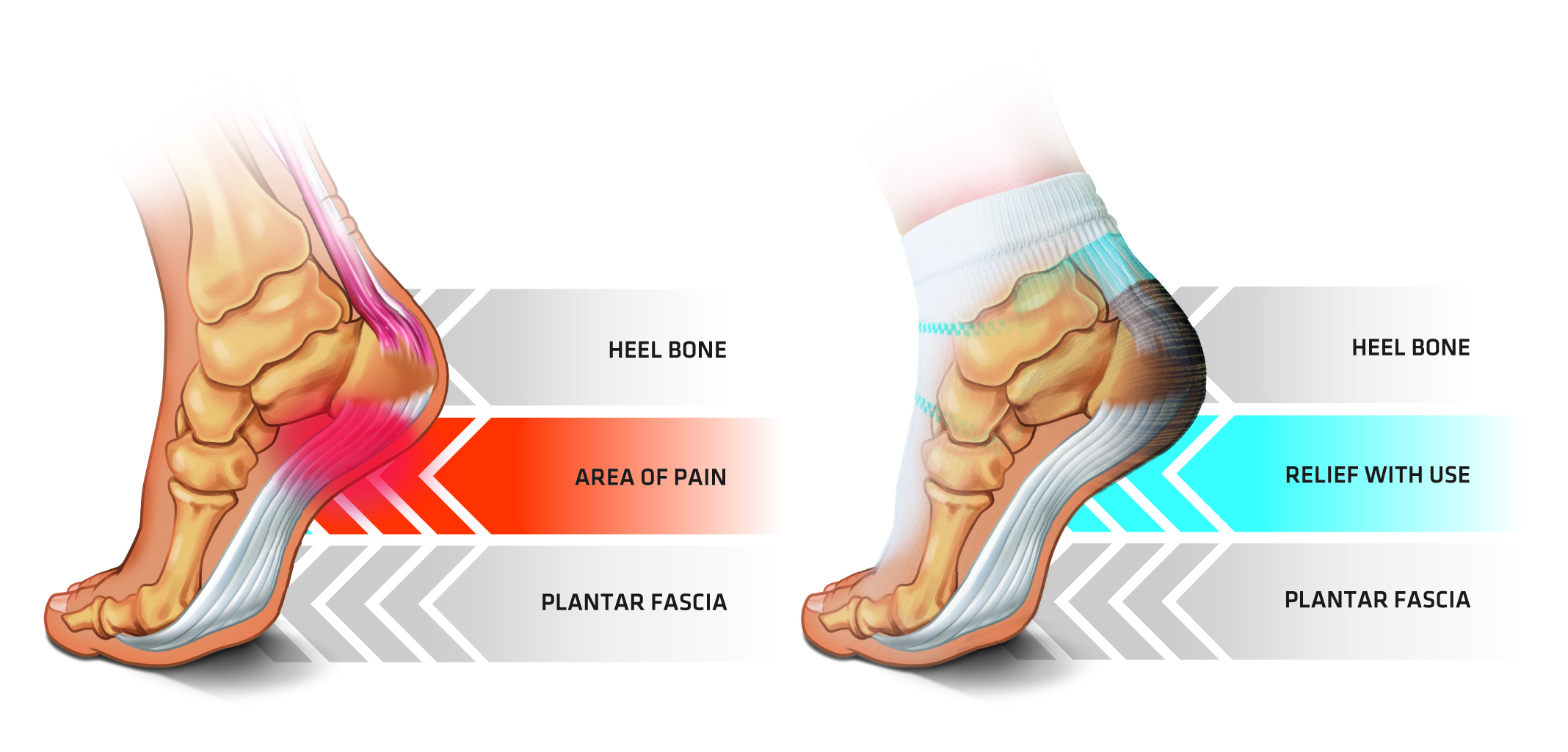 Plantar Fasciitis Diagram Exatin info