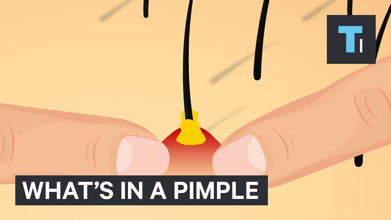 Blind Pimple Diagram All The Nasty Things Inside A Pimple