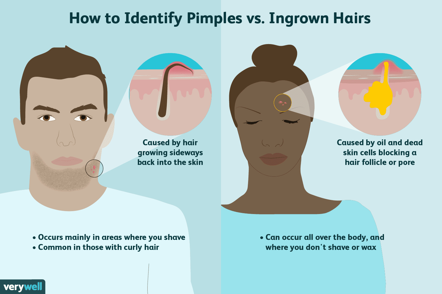Blind Pimple Diagram Difference Between A Pimple And An Ingrown Hair