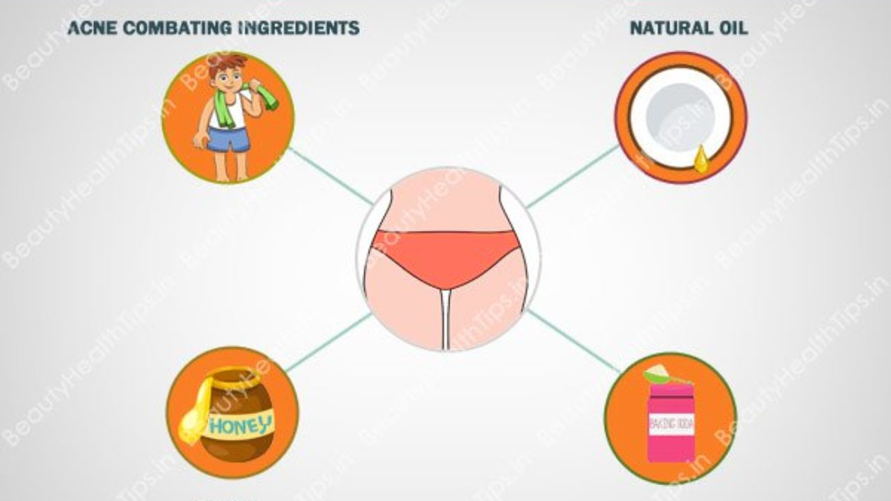 Blind Pimple Diagram How To Remove Acne On Buttocks Butt Pimples Buttock Zits Naturally