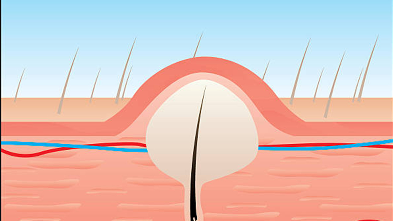 Blind Pimple Diagram What Is A Pilonidal Cyst