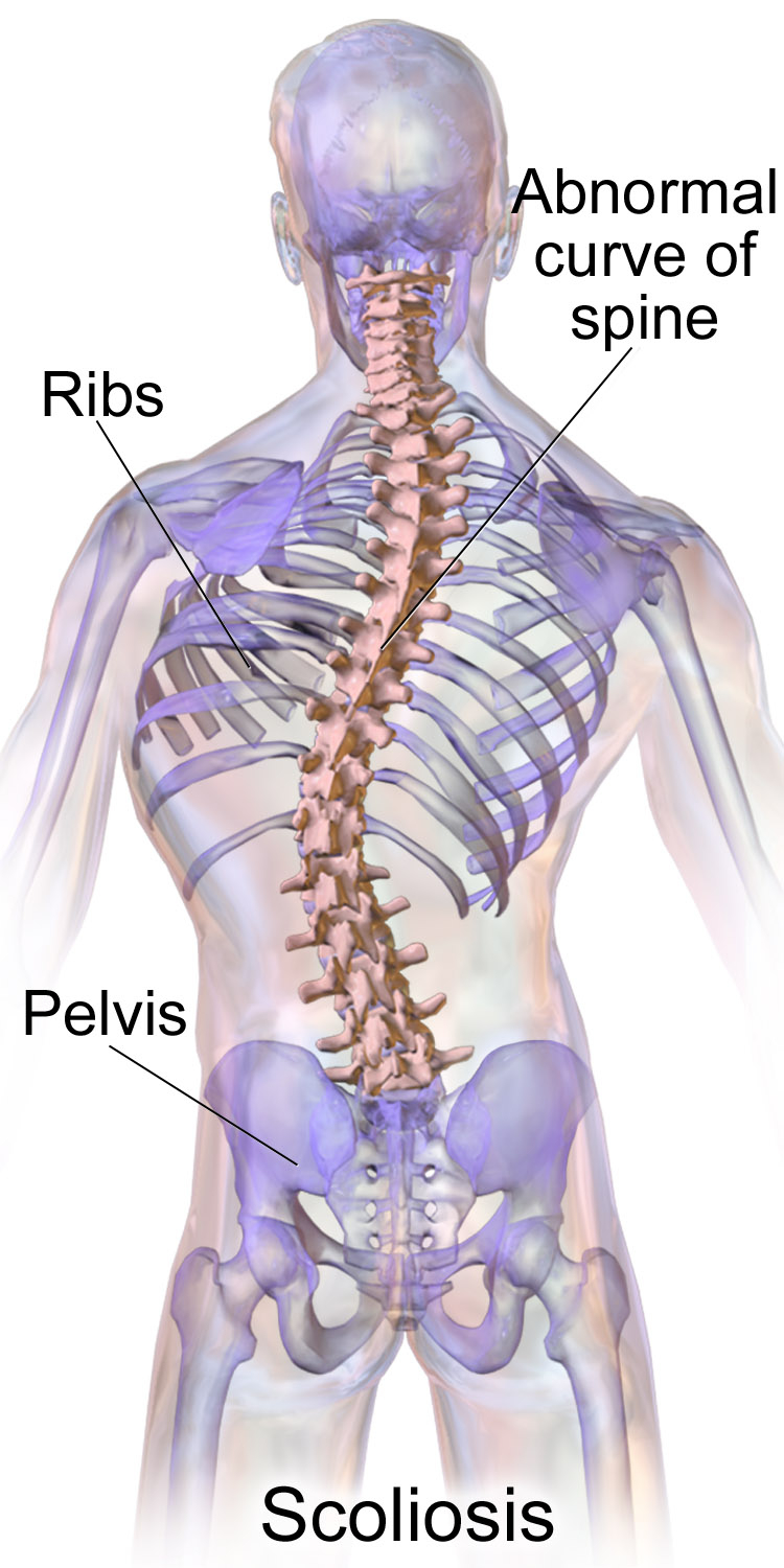 Diagram Of Back Scoliosis Wikipedia
