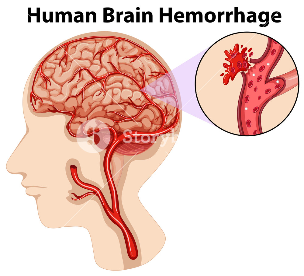 Diagram Of Brain Diagram Of Human Brain Hemorrhage Illustration Royalty Free Stock