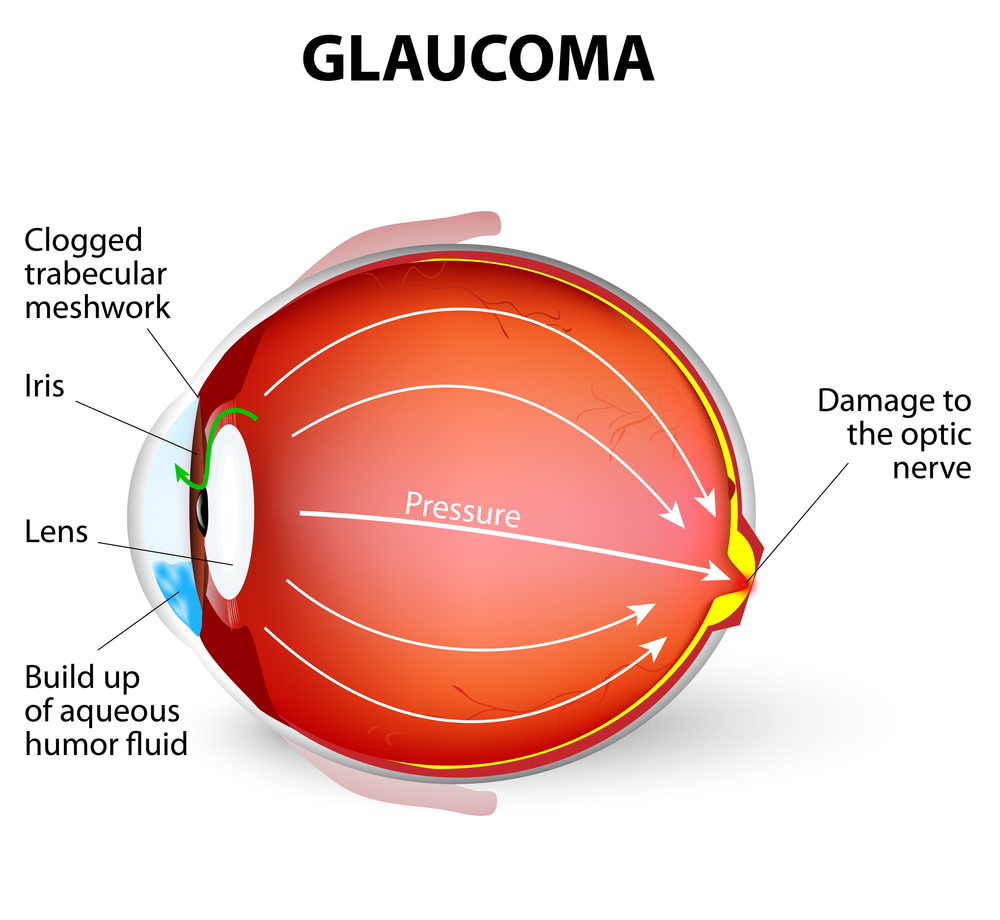 Diagram Of Eye Glaucoma Diagram Discovery Eye Foundation