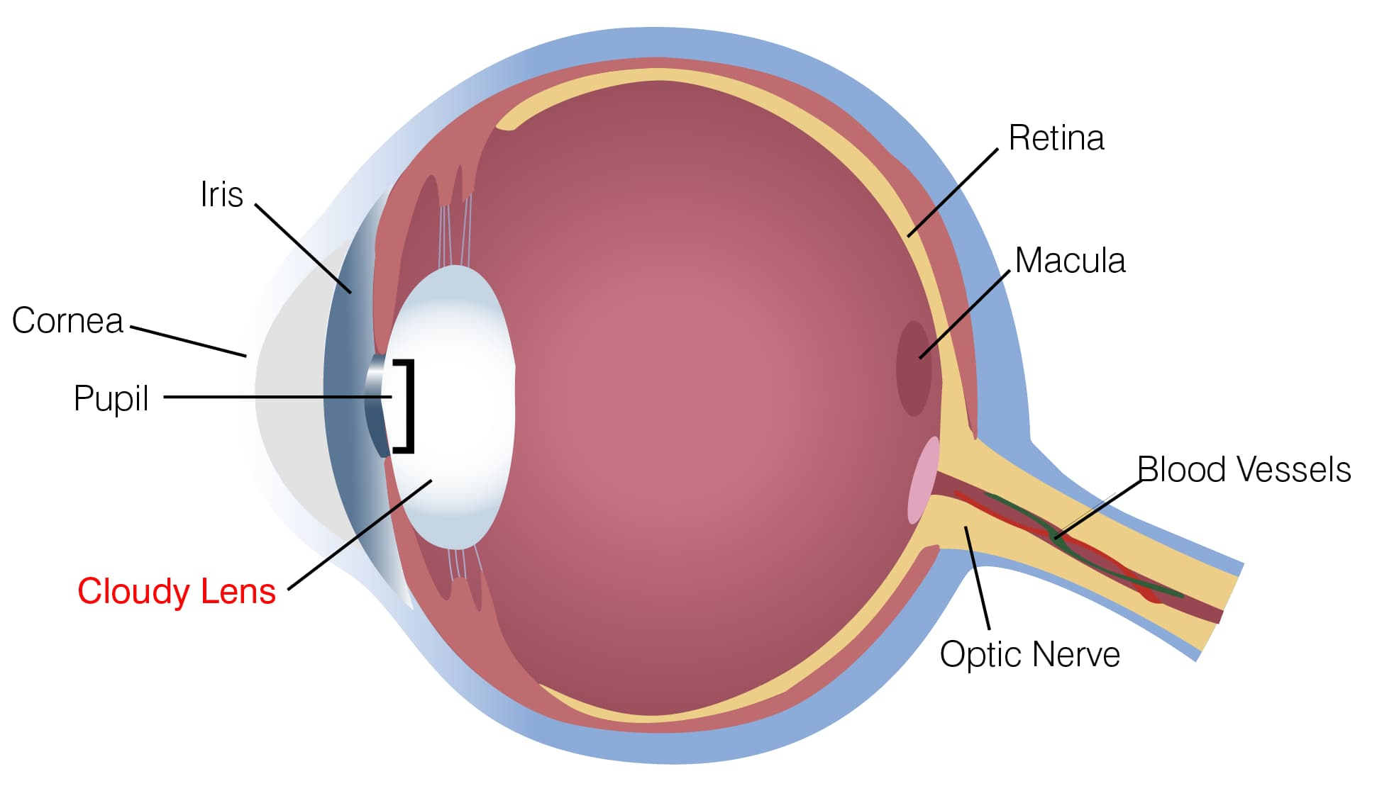 Diagram Of Eye Learn About Eye Diseases Cataracts Eyeglass World