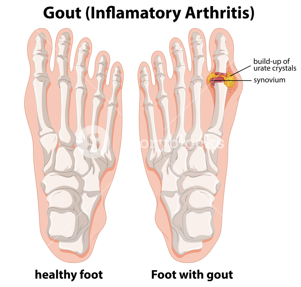 Diagram Of Foot Diagram Explanation Of Gout In Human Foot Illustration Royalty Free