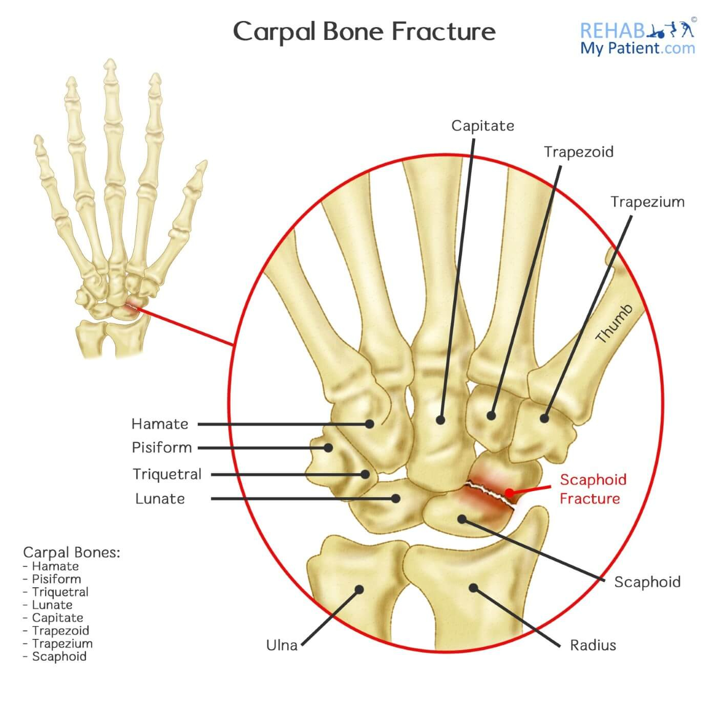 Diagram Of Hand Bones Carpal Bone Fracture Rehab My Patient