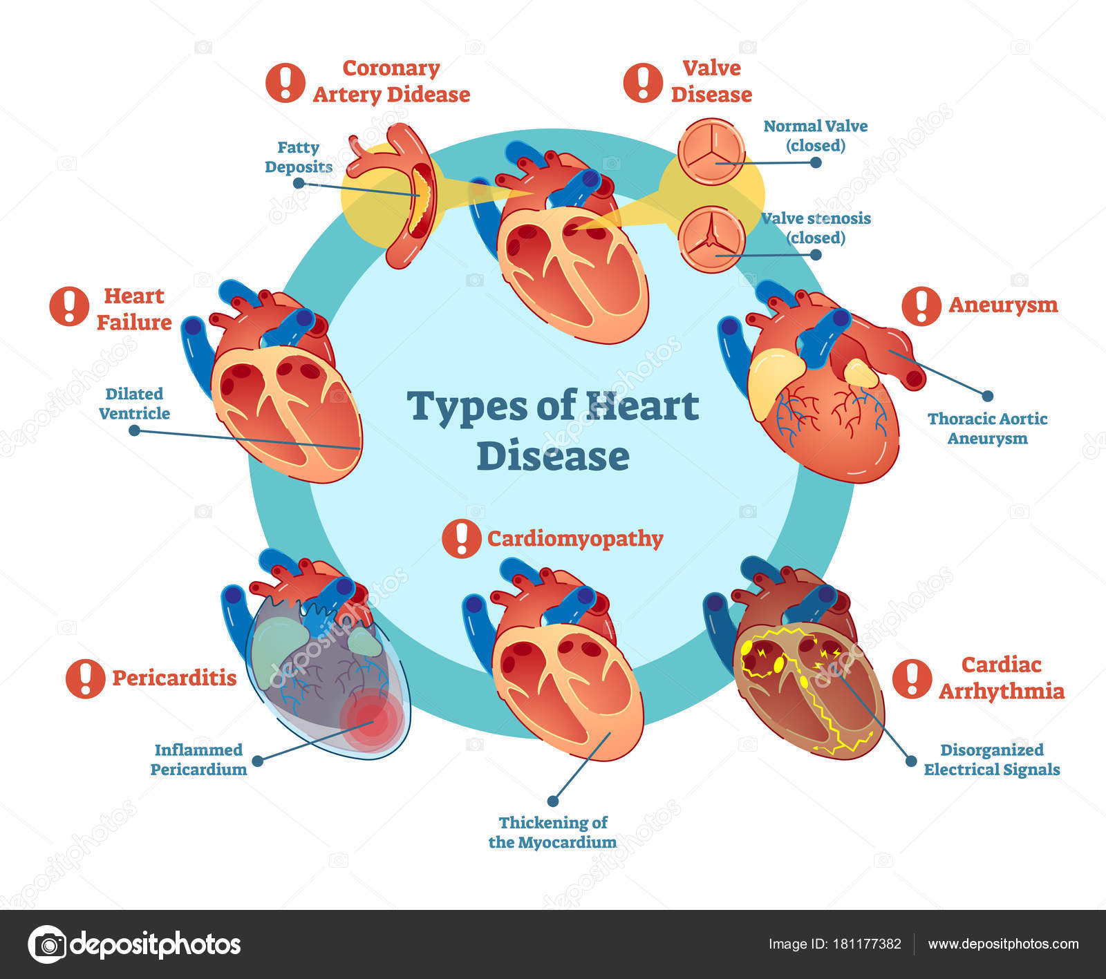 Diagram Of Heart Types Of Heart Disease Collection Vector Illustration Diagram