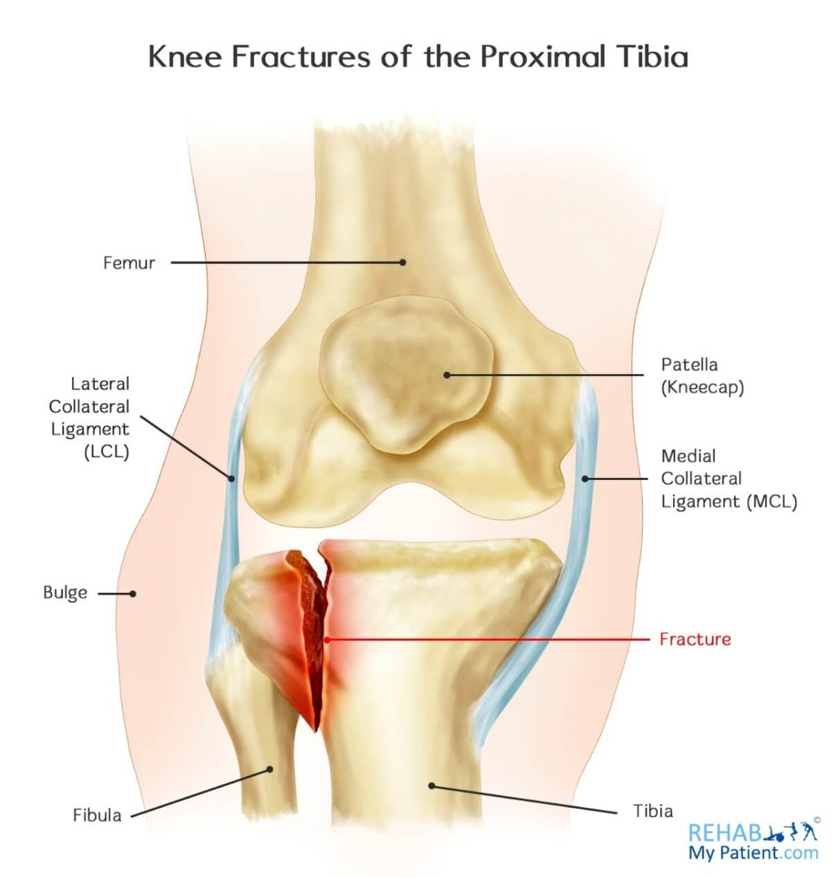 Diagram Of Knee Broken Knee Bones Diagram Wiring Diagrams User