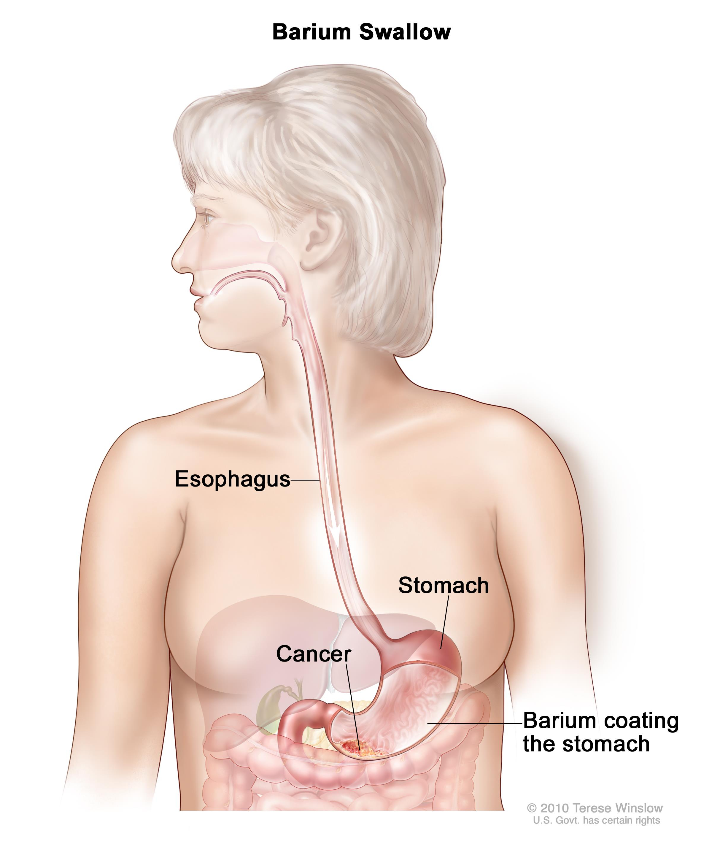 Diagram Of Stomach General Surgery Stomach Gastric Cancer