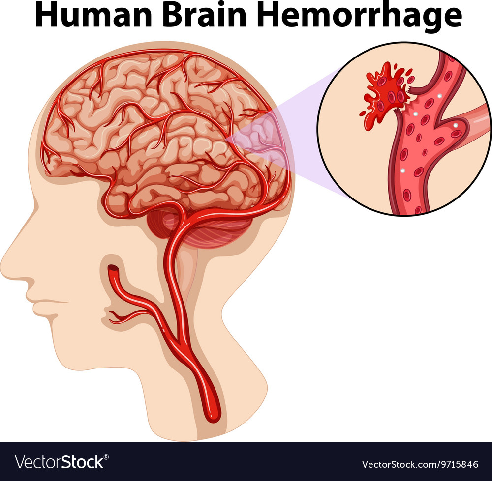 Diagram Of The Brain Diagram Of Human Brain Hemorrhage