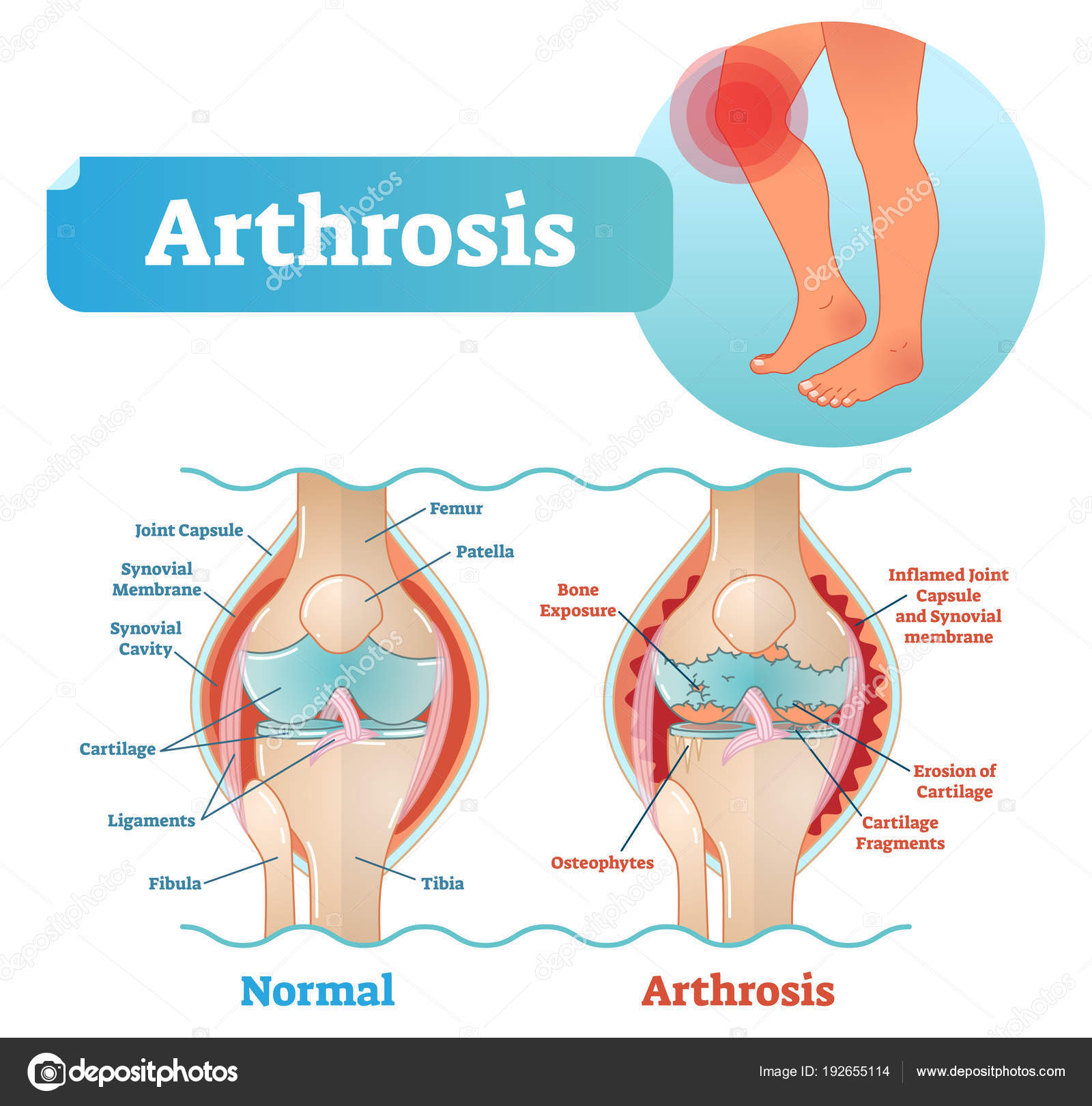 Diagram Of The Knee Arthrosis Medical Vector Illustration Diagram With Damaged Knee