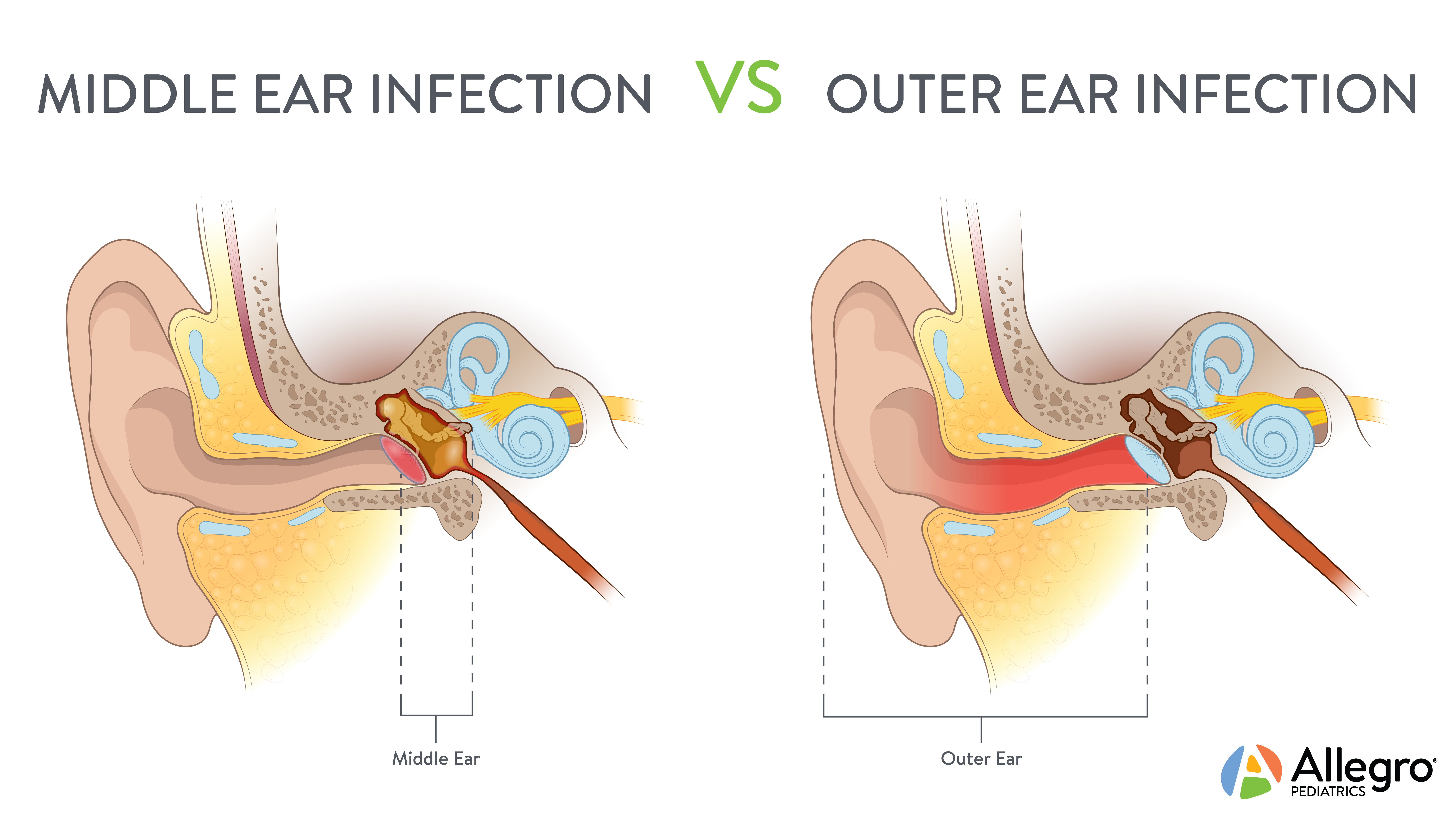 Ear Infection Diagram Ear Infections Allegro Pediatrics