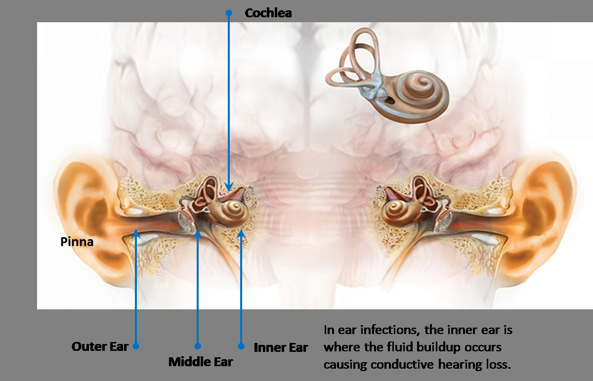 Ear Infection Diagram Ear Infections And Hearing Loss Hearing Rehab Center