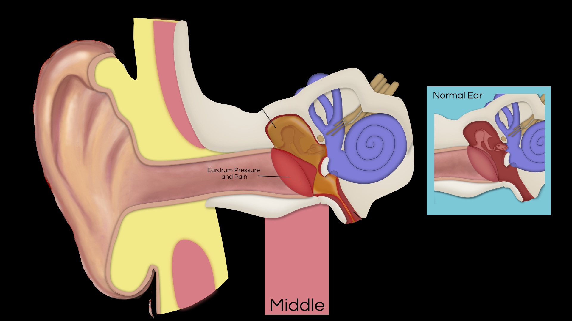 Ear Infection Diagram Ear Infections Ear Institute Of Texas And Voice Swallowing