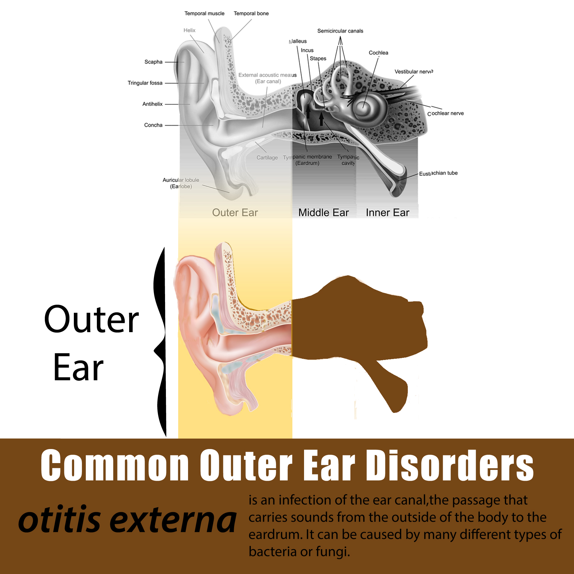 Ear Infection Diagram Learn About Ear Infections Hear Sense