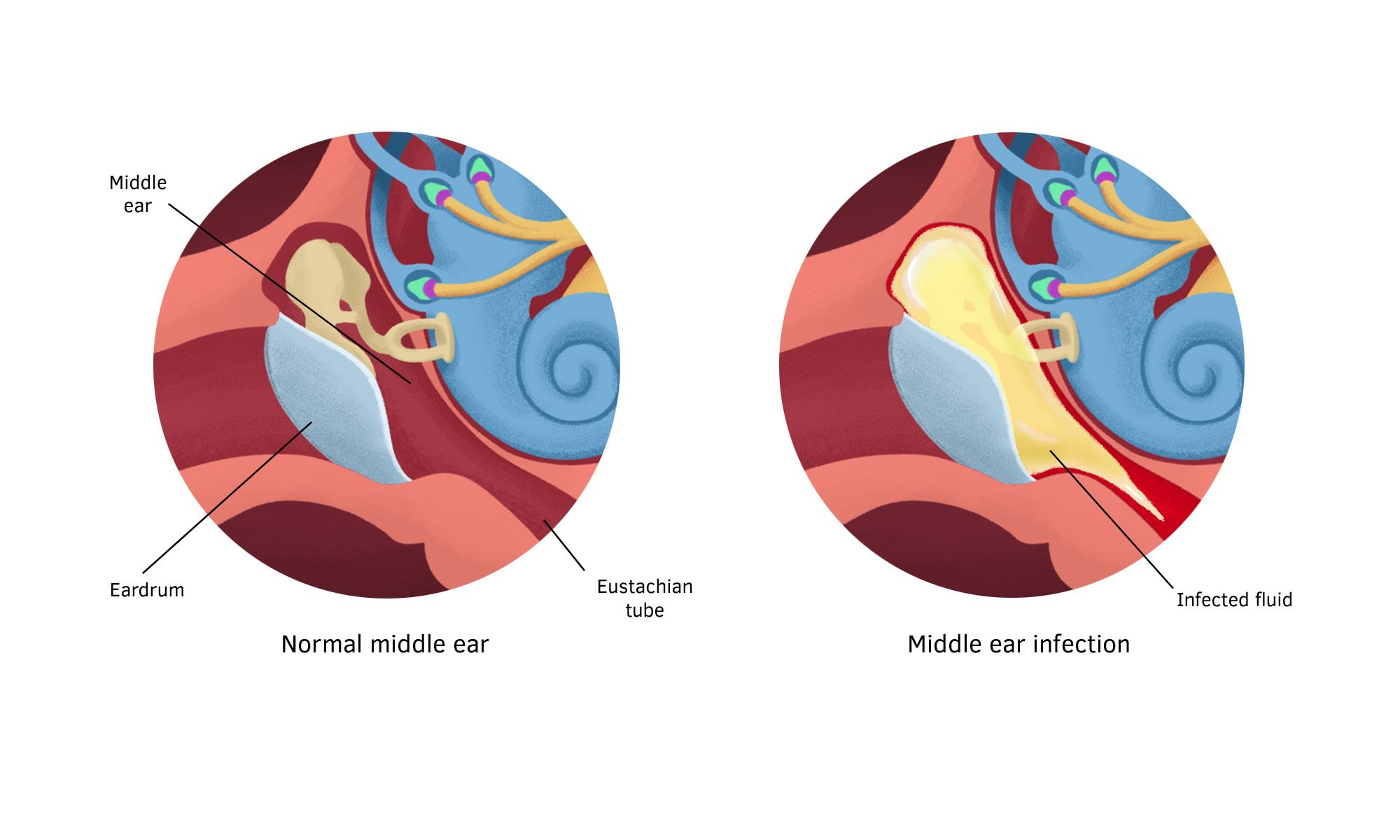 Ear Infection Diagram Middle Ear Infections Healthand