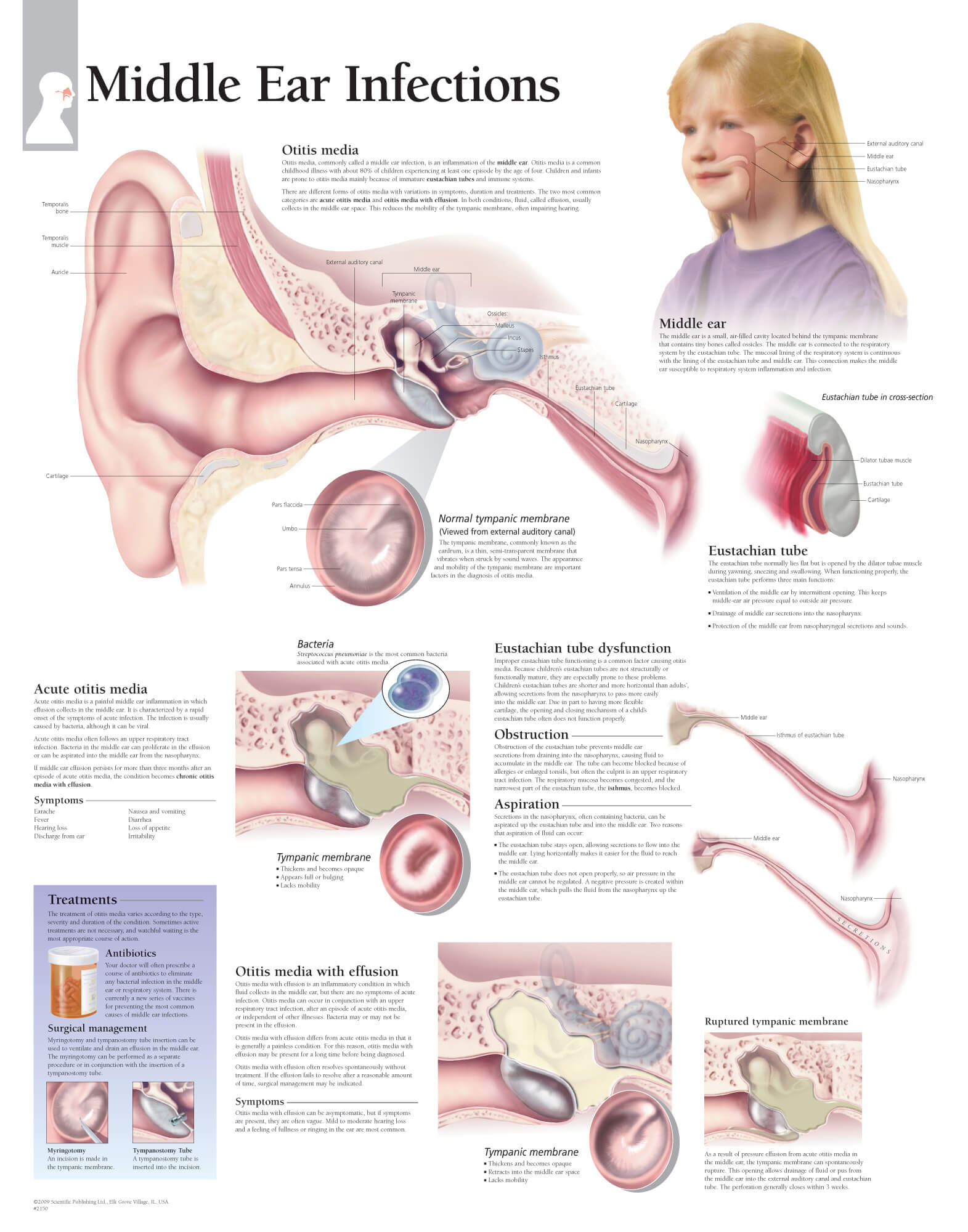 Ear Infection Diagram Middle Ear Infections