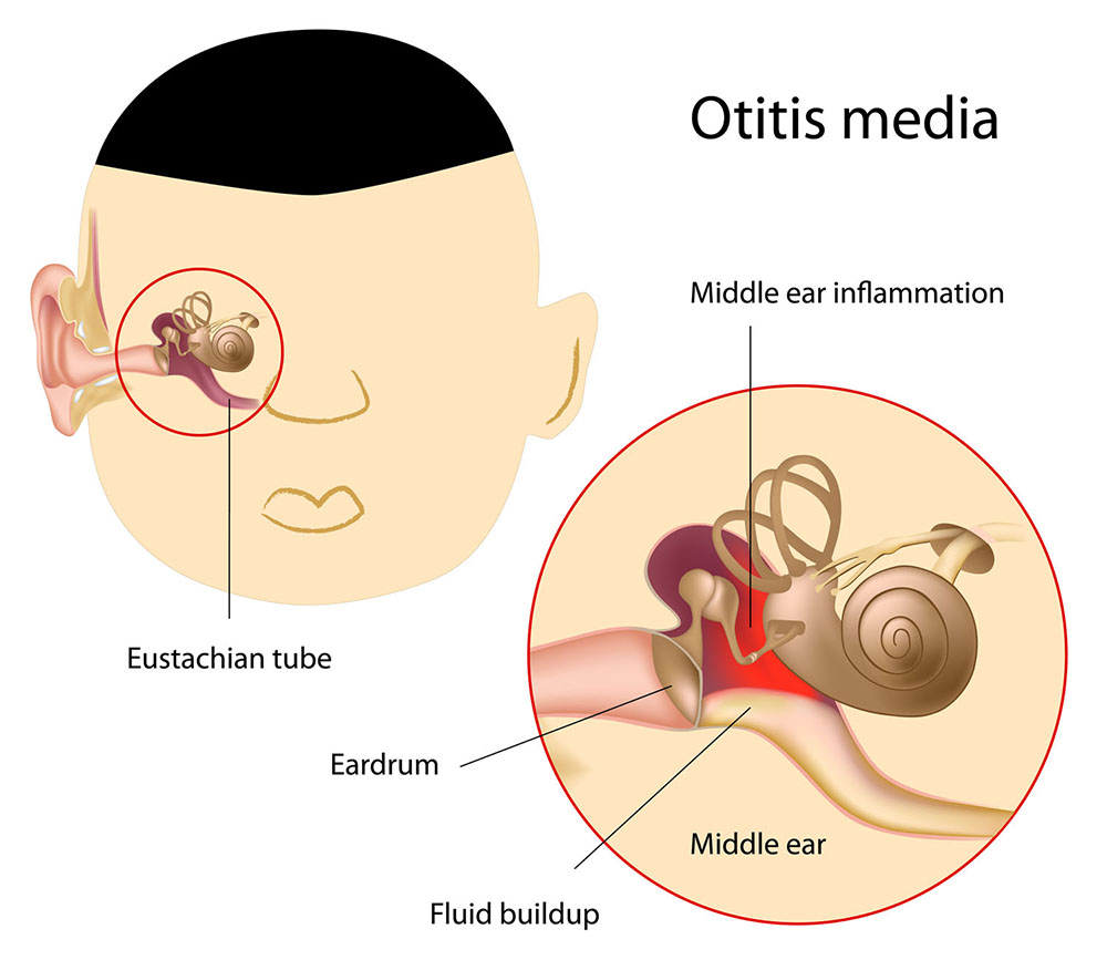 Ear Infection Diagram Otitis Media Middle Ear Infection Healthdirect