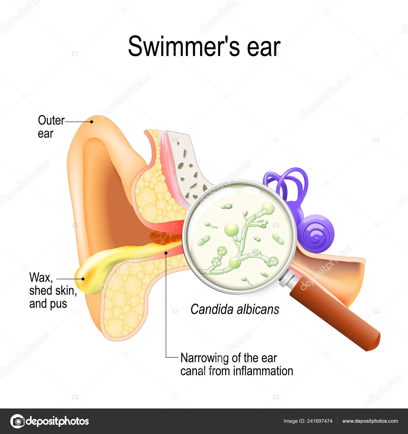 Ear Infection Diagram Otitis Swimmer Ear Inflammation Ear Canal Fungal Infection Caused