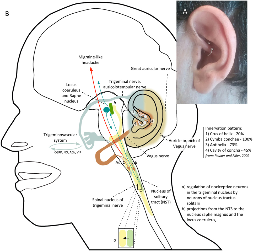 Ear Piercing Diagram Frontiers Daith Piercing In A Case Of Chronic Migraine A Possible