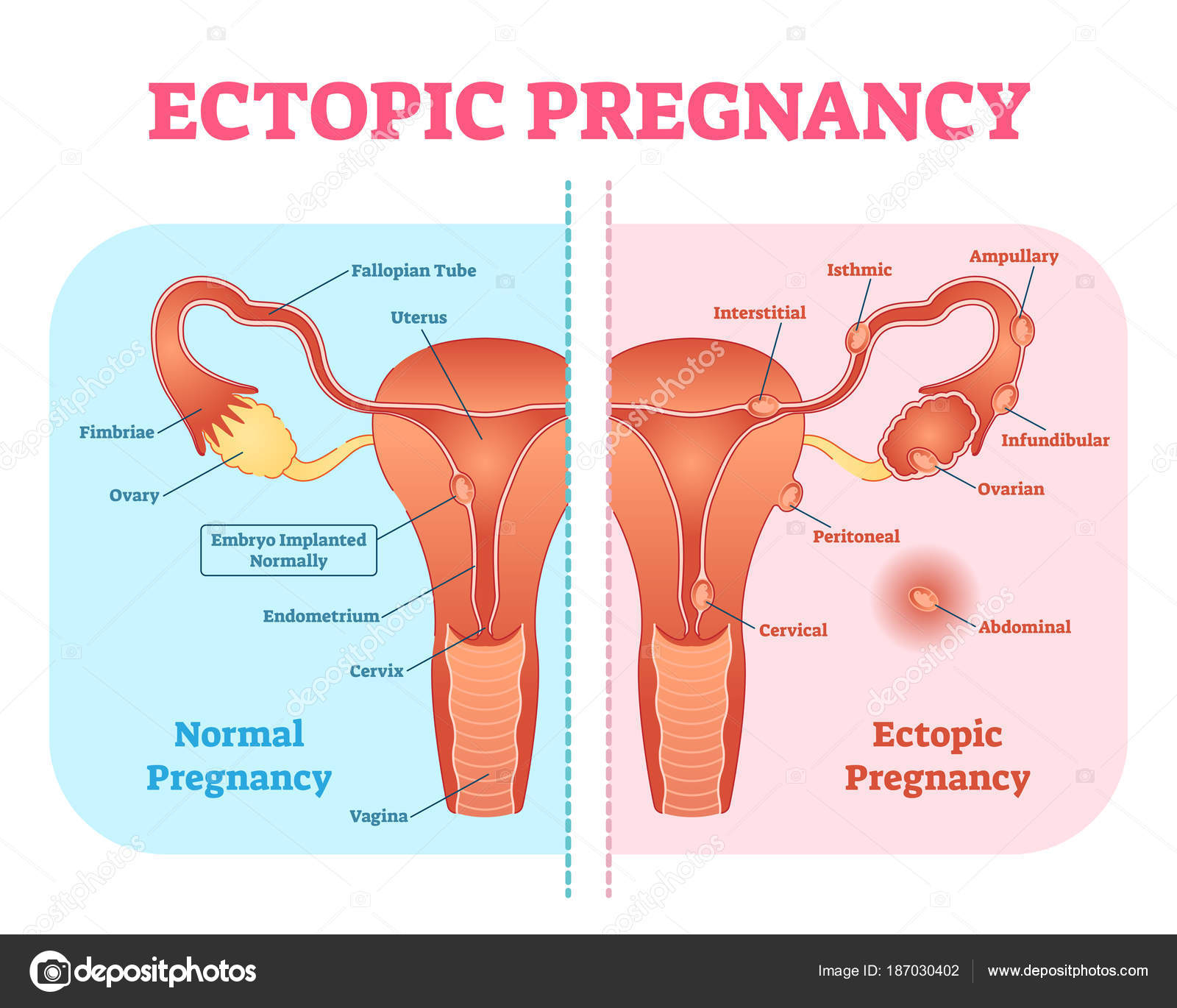 Female Reproductive System Diagram Ectopic Pregnancy Or Tubal Pregnancy Medical Diagram With Female