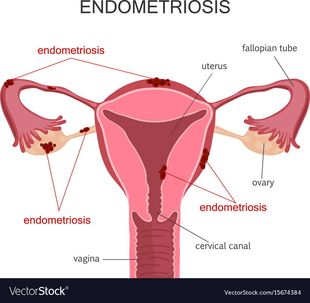 Female Reproductive System Diagram Uterus Endometriosis Diagram