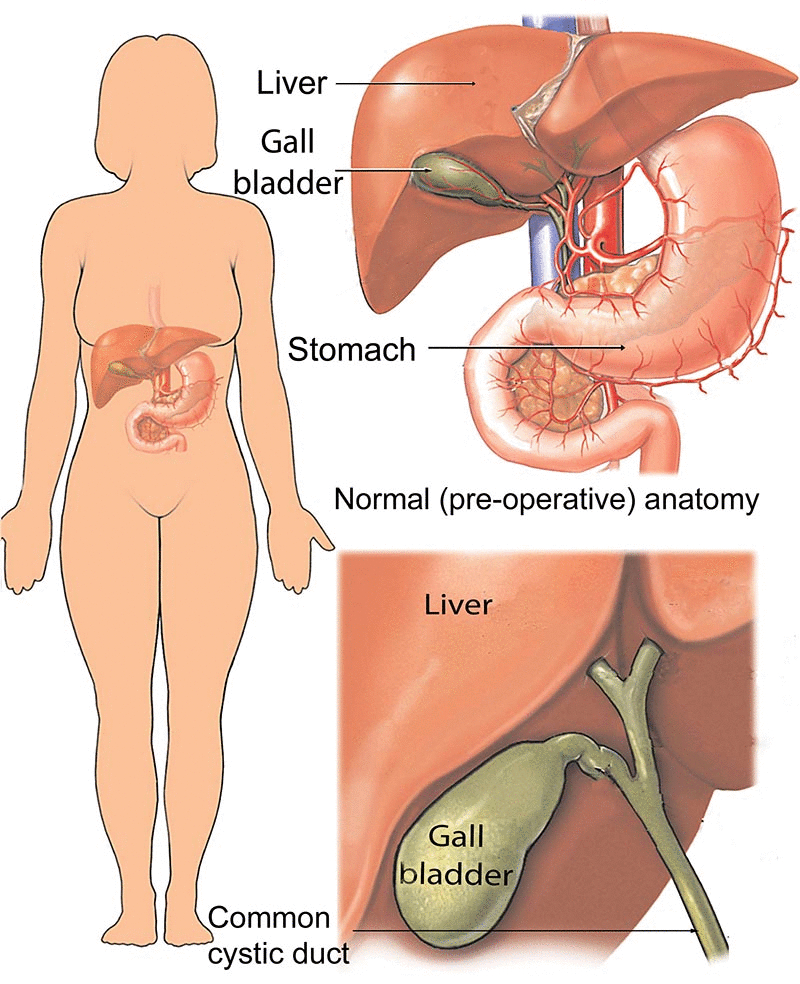 Gallbladder Pain Location Diagram Cholecystitis Gallbladder Inflammation Healthdirect