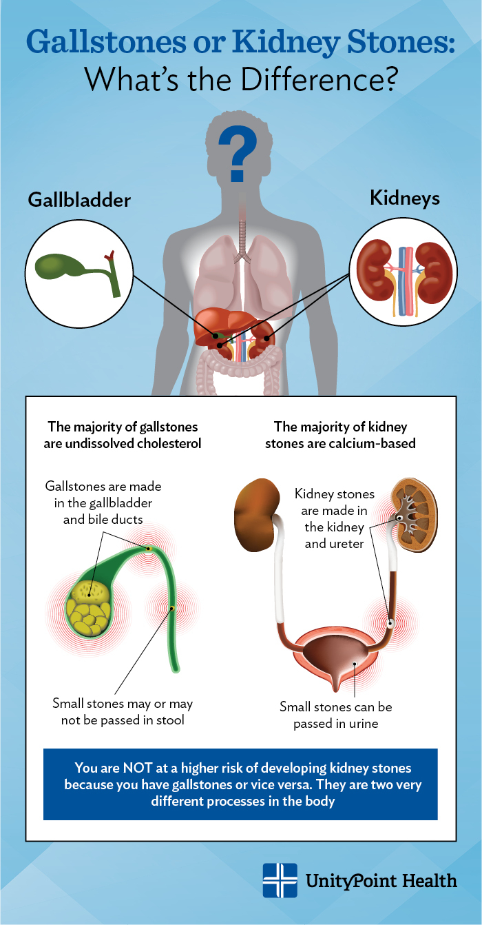 Gallbladder Pain Location Diagram Fact Finding Gallstones Vs Kidney Stones Unitypoint Health