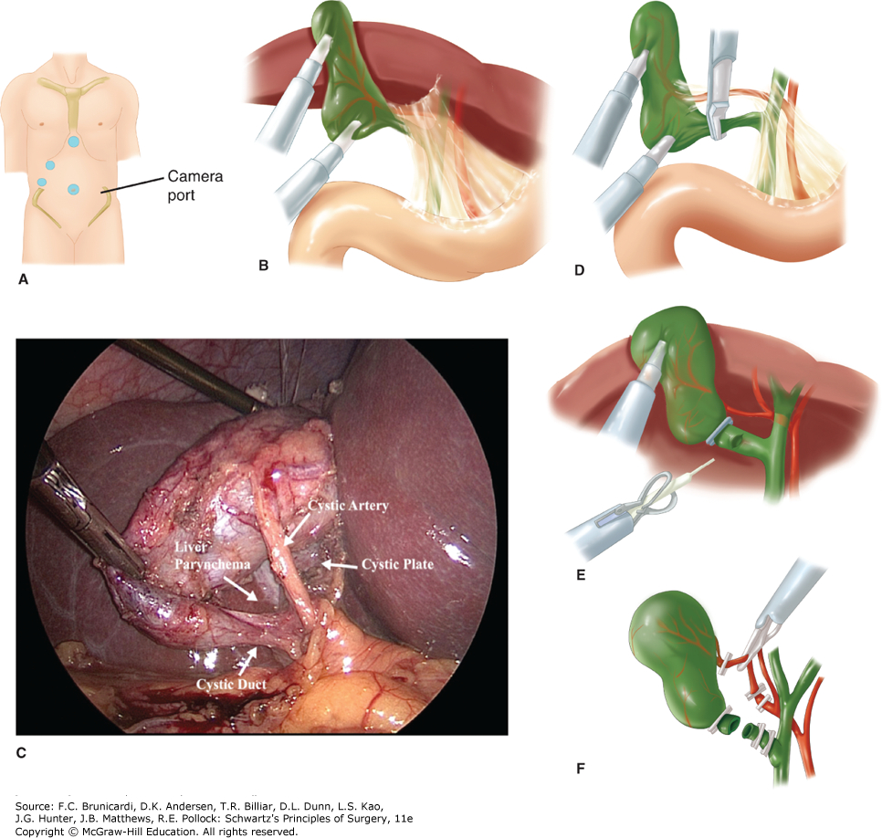 Gallbladder Pain Location Diagram Gallbladder And The Extrahepatic Biliary System Schwartzs