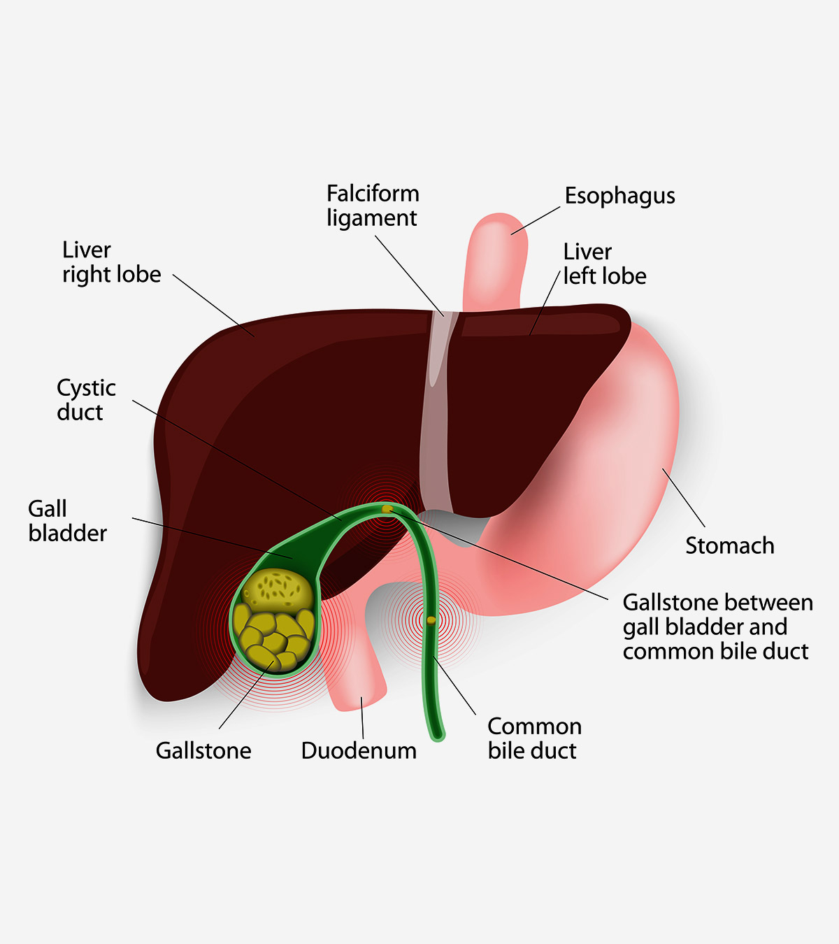 Gallbladder Pain Location Diagram Gallstones In Children Everything You Need To Know