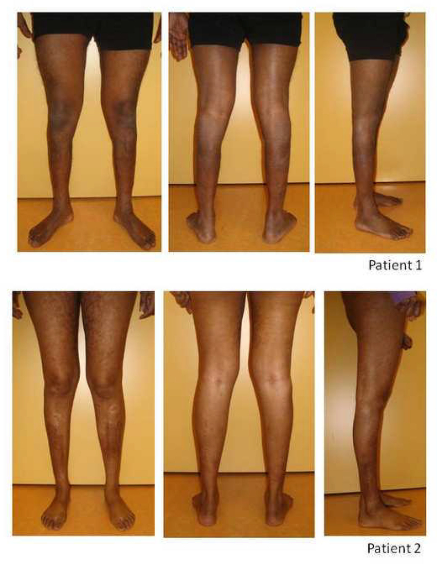 Leg Muscle Diagram Muscle Atrophy In Lower Legs Anterior Distal Asymmetrical Right