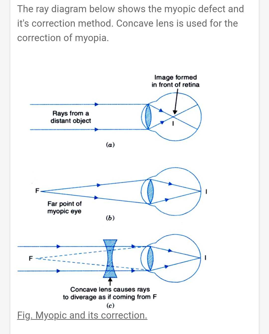 Lens Ray Diagrams 3 Draw A Ray Diagram For The Defect And Correctness Of A My Scholr