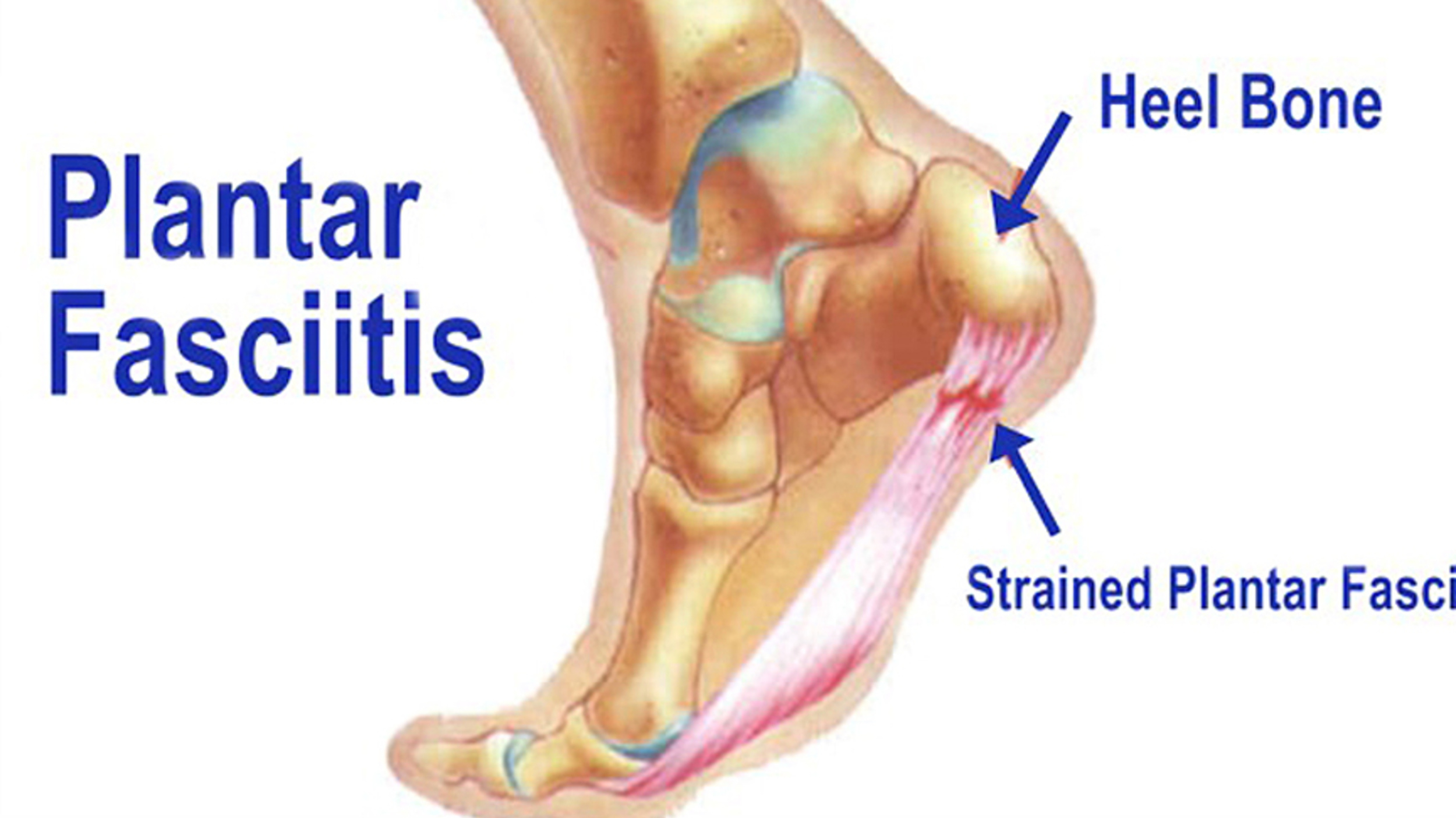 Plantar Fasciitis Diagram Brampton Mississauga Foot Pain Clinic Heel Pain