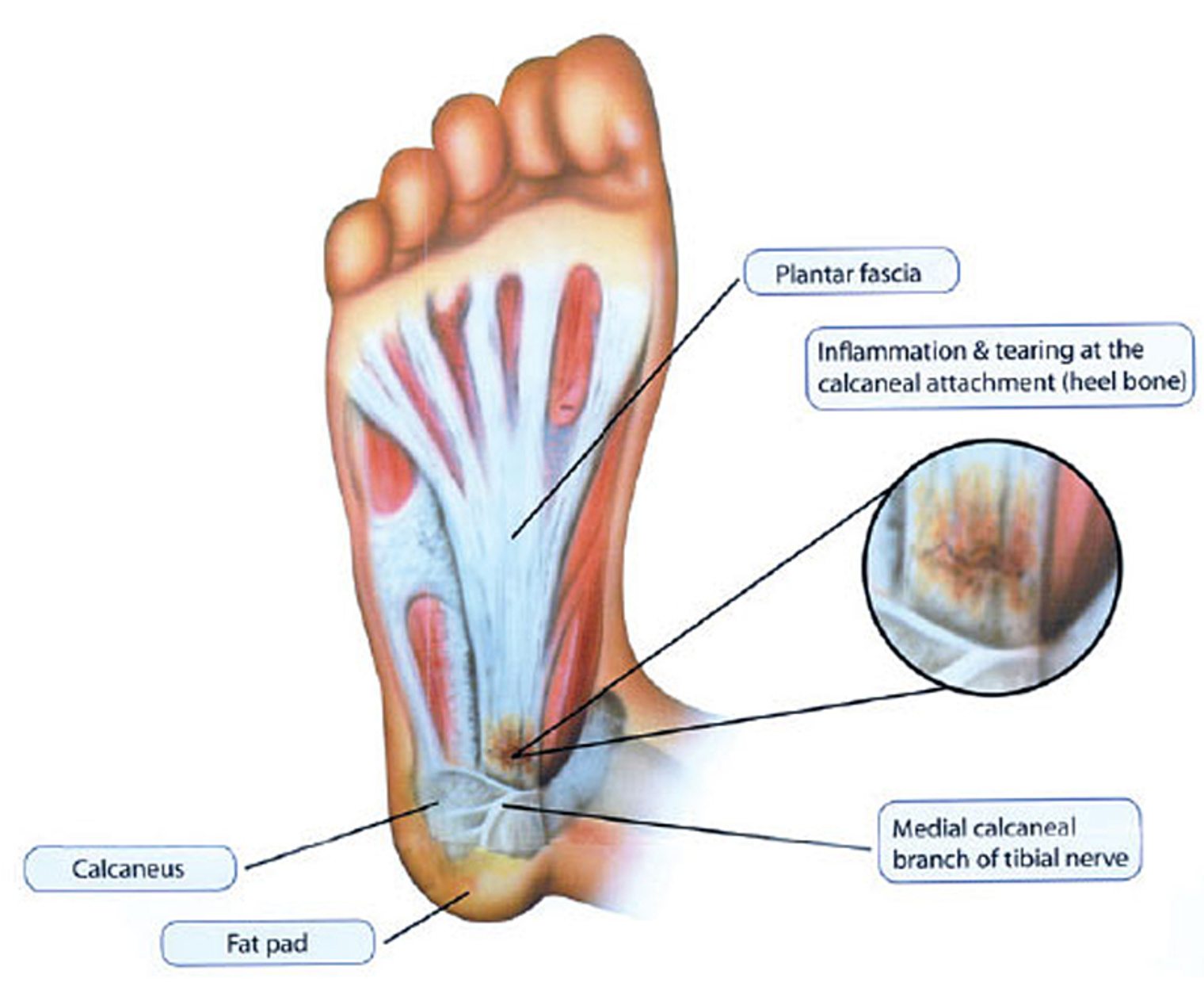Plantar Fasciitis Diagram Brampton Mississauga Foot Pain Clinic Heel Pain