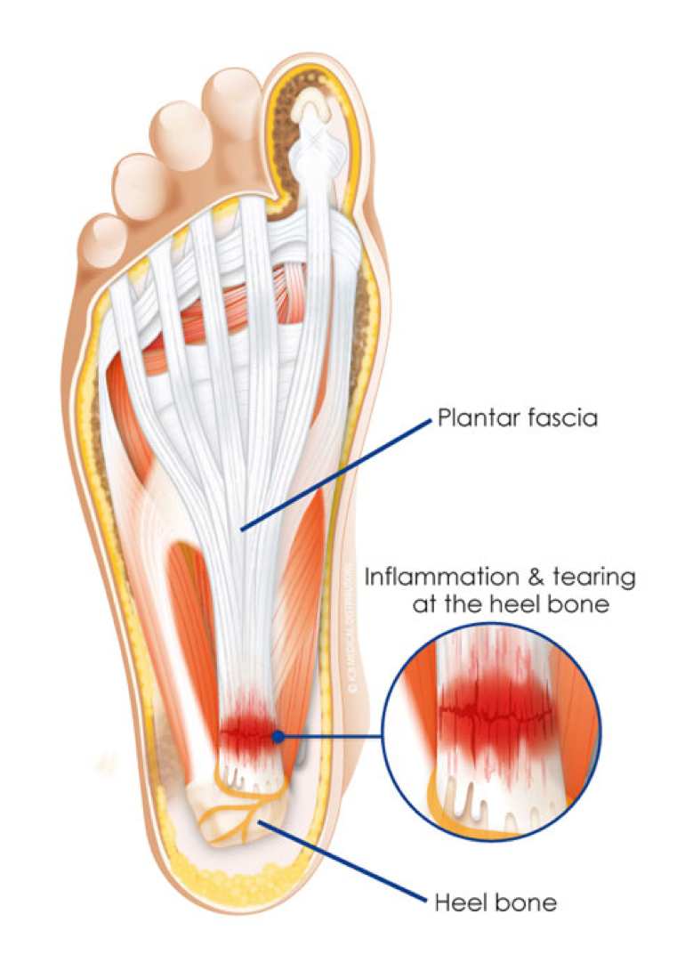 Plantar Fasciitis Diagram Can Physiotherapy Help My Plantar Fasciitis Active Care Physiotherapy
