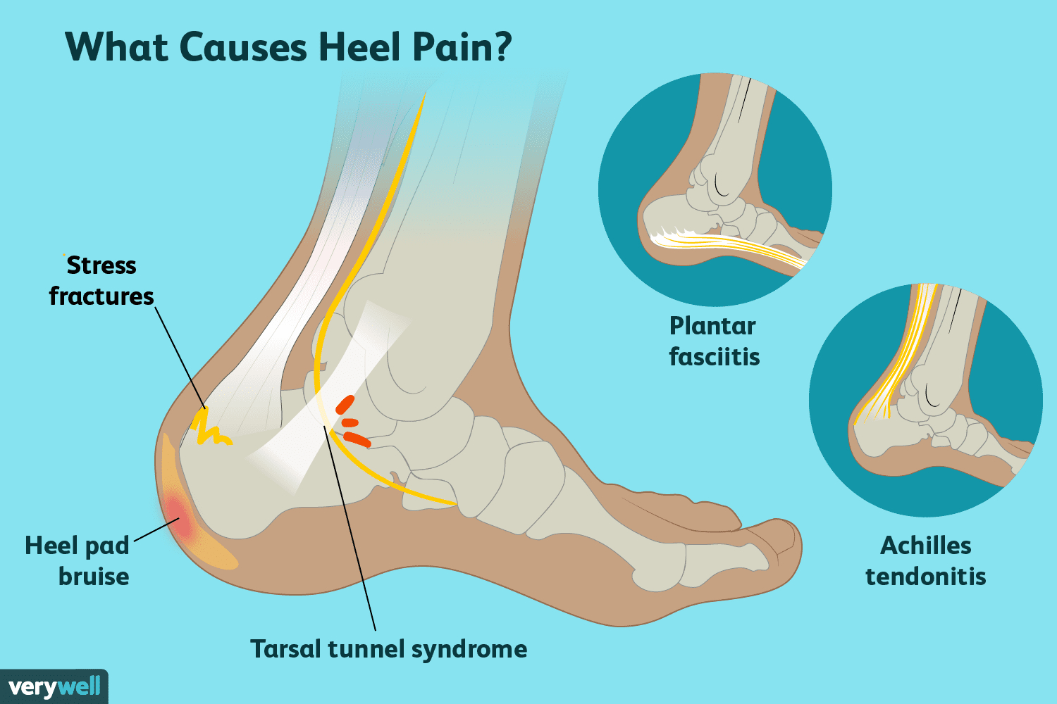 Plantar Fasciitis Diagram Heel Pain Causes Treatment And When To See A Doctor