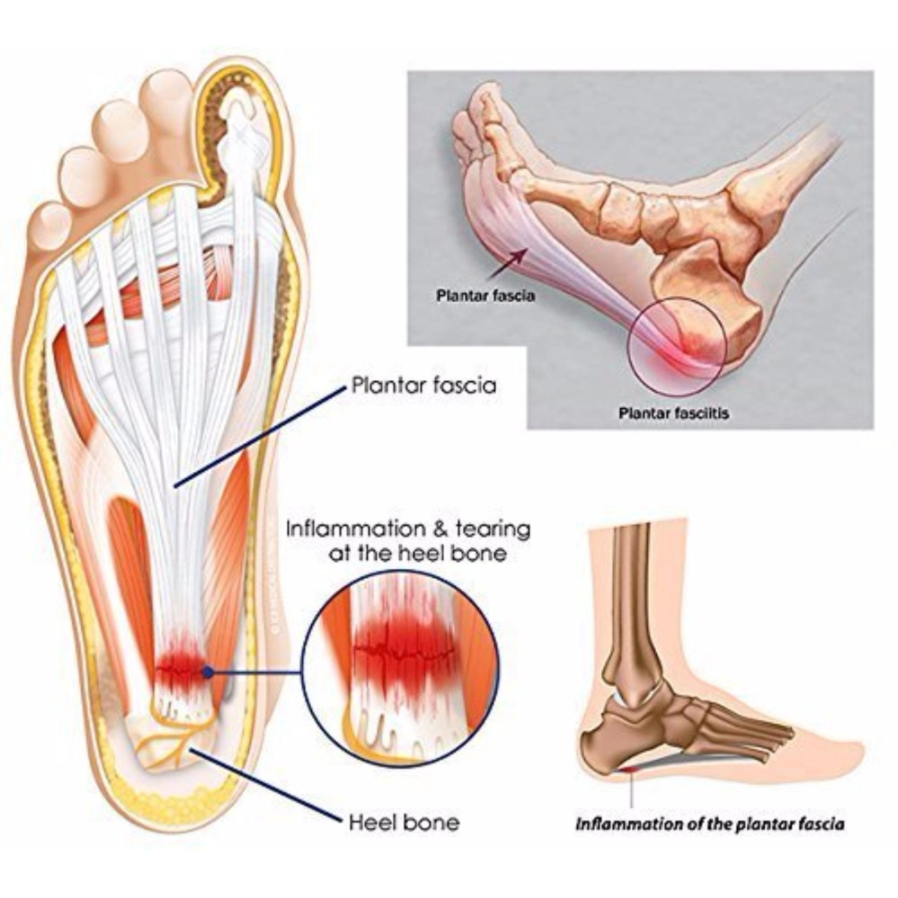 Plantar Fasciitis Diagram Pejke Aptoco Plantar Fasciitis Therapy Wrap Arch Support Relieve Heel Pain Sock