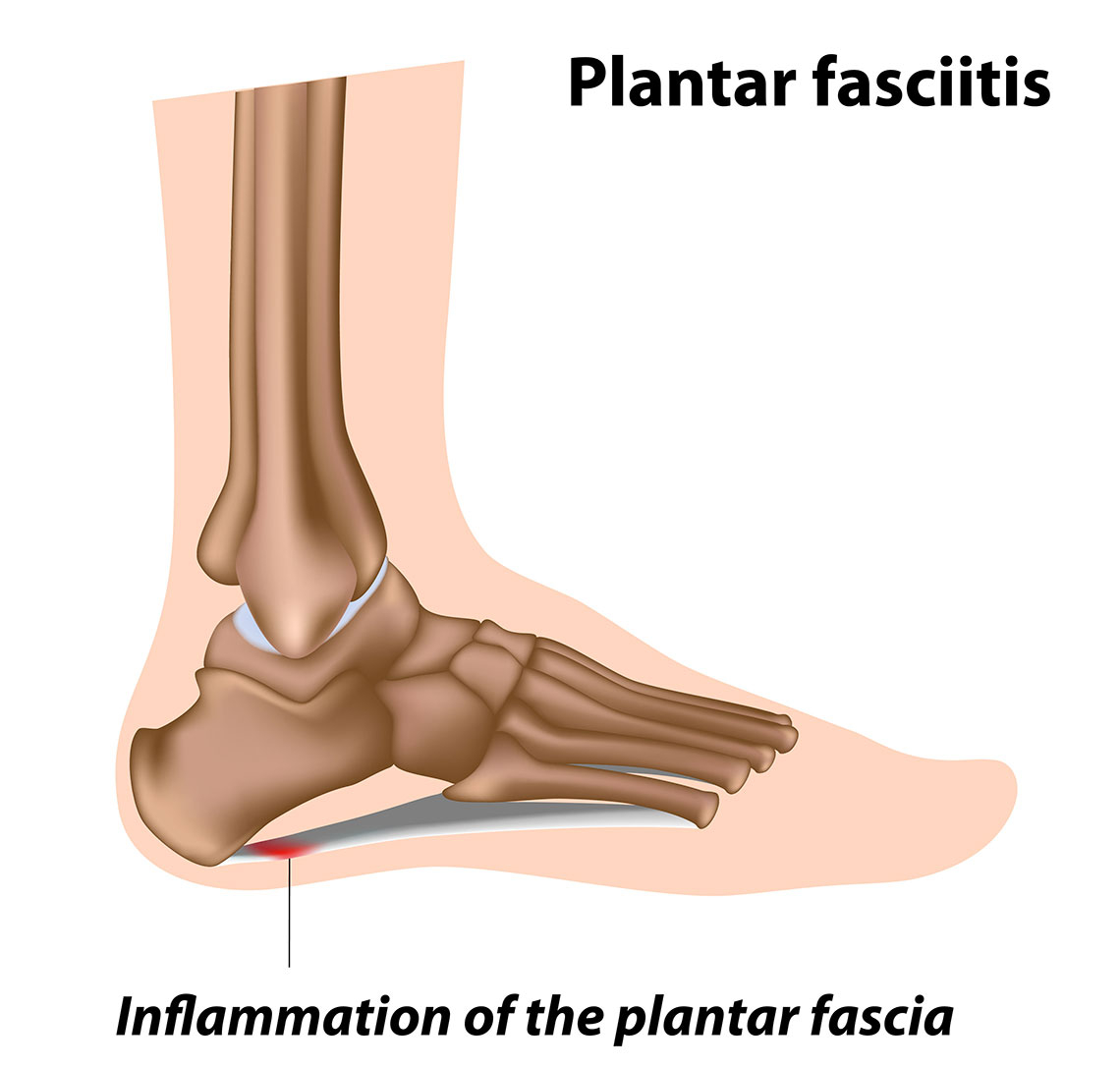 Plantar Fasciitis Diagram Plantar Fasciitis And Heel Pain Test Your Knowledge