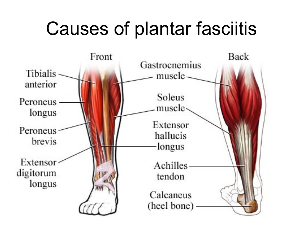 Plantar Fasciitis Diagram What Causes Plantar Fasciitis