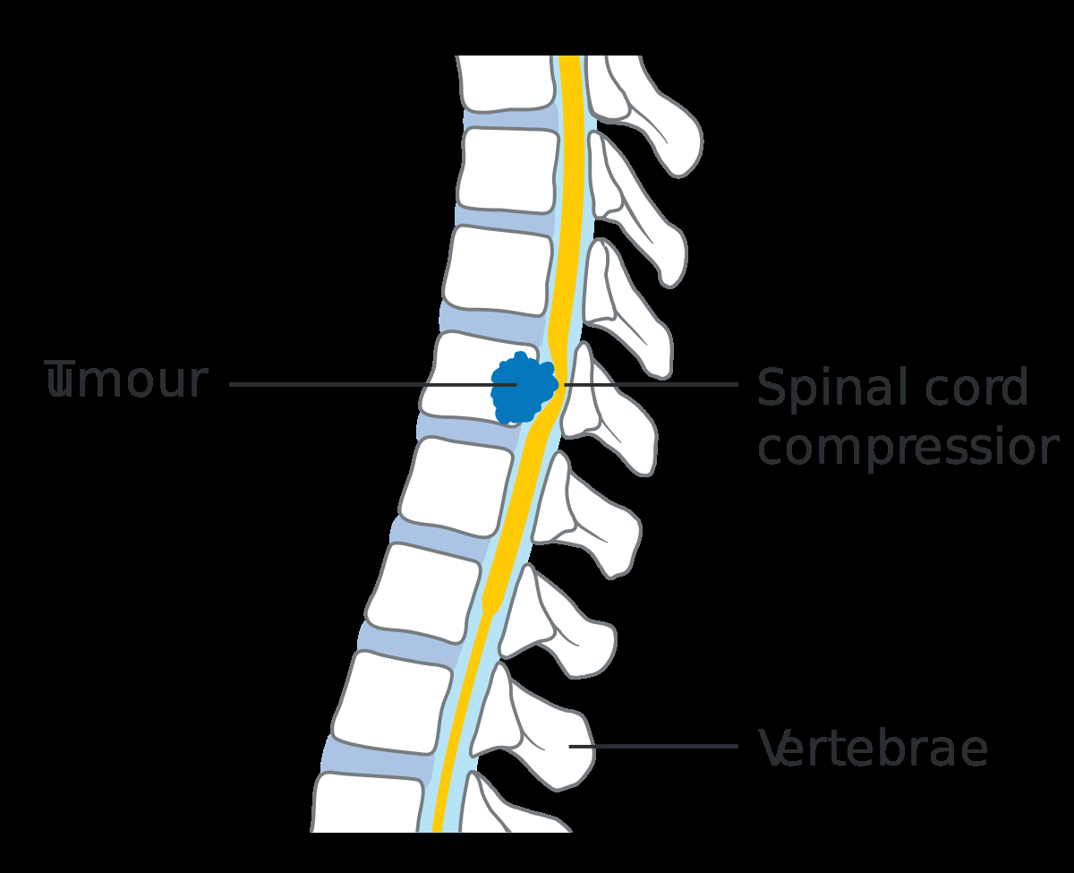 Spinal Cord Diagram Spinal Cord Compression Wikipedia