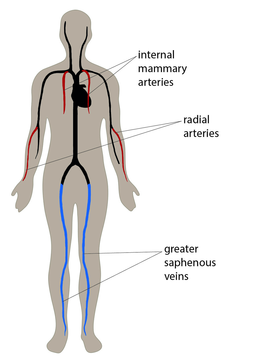 Veins And Arteries Diagram Coronary Artery Pass Graft Cabg How Its Performed Nhs