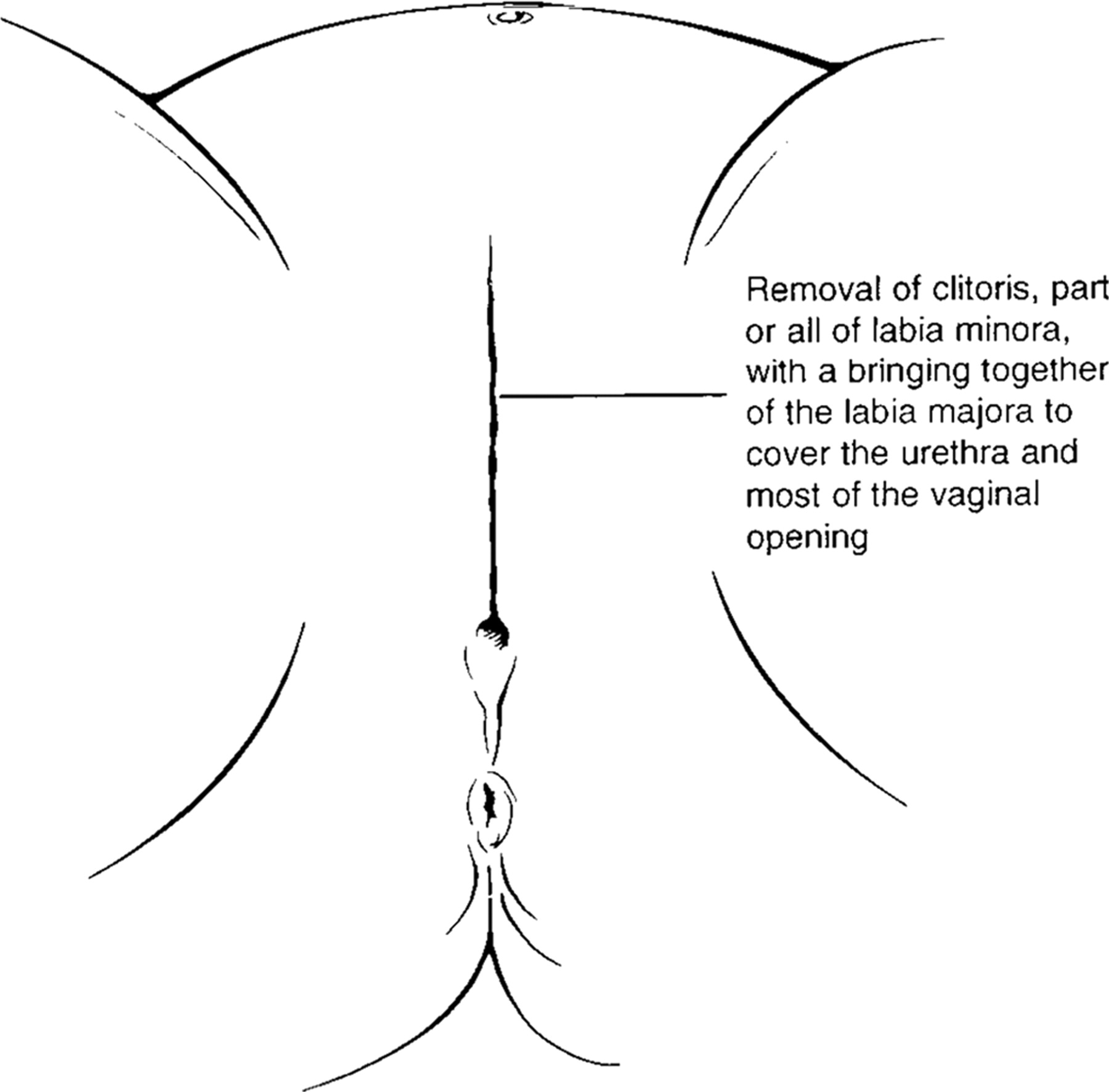 Women's Genitalia Diagram Ritual Genital Cutting Of Female Minors From The American Academy
