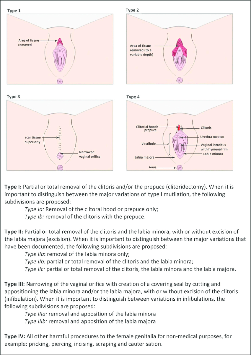 Women's Genitalia Diagram Who Classification Of Female Genital Mutilationcutting Fgmc